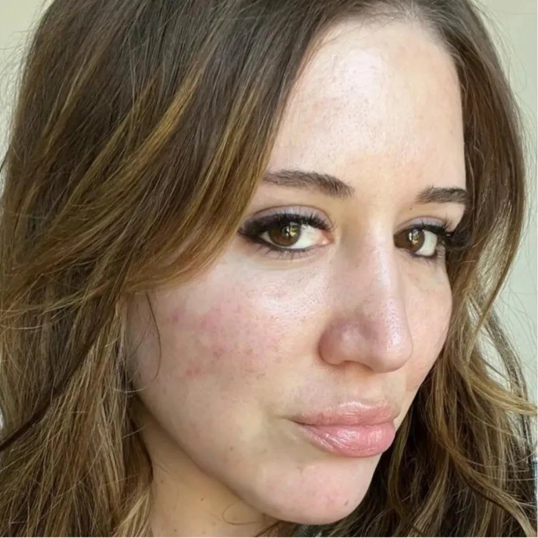Pele com acne: antes